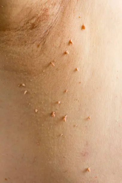 Skin Wart